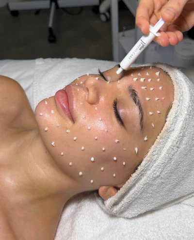 Cellstory liquid microneedling treatment at EBSKIN — precision meso-care application for skin renewal and corrective results.